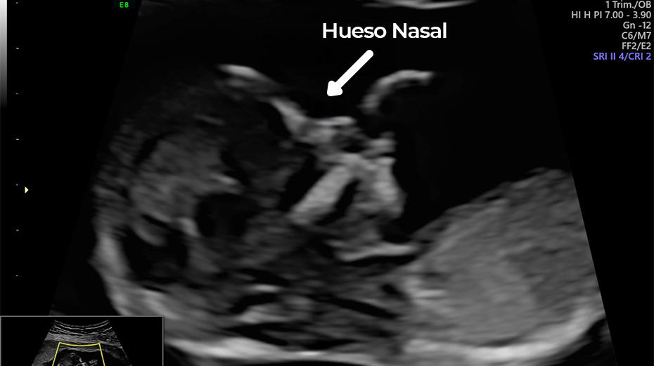Hueso Nasal